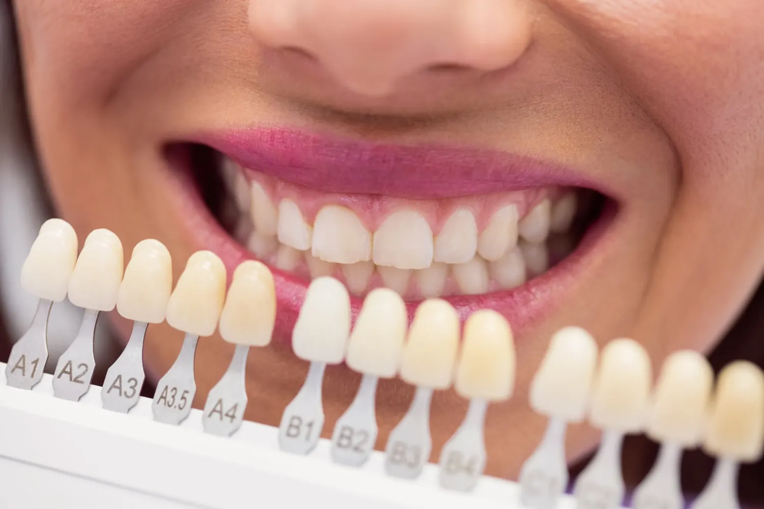 Guía de tonos VITA comparada con la sonrisa de una paciente